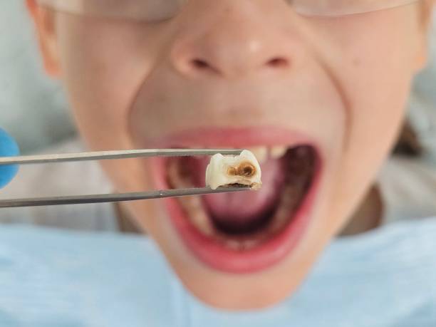 Best Broken or Chipped Tooth Repair in Grand Junction, CO
